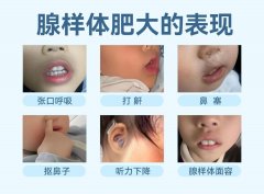 孩子腺样体肥大到底要不要管？耳