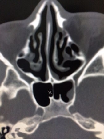 鼻窦炎CT检查图