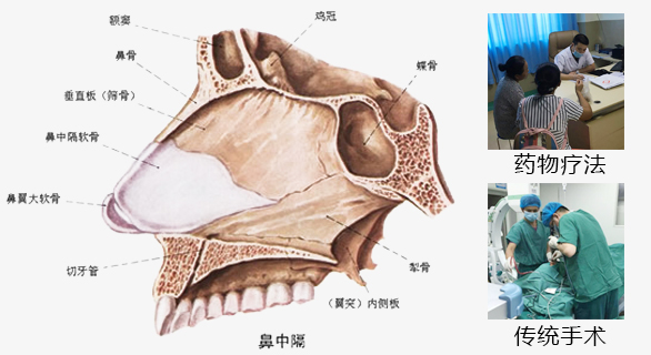 鼻中隔偏曲的治疗方法