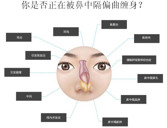 鼻中隔偏曲的危害