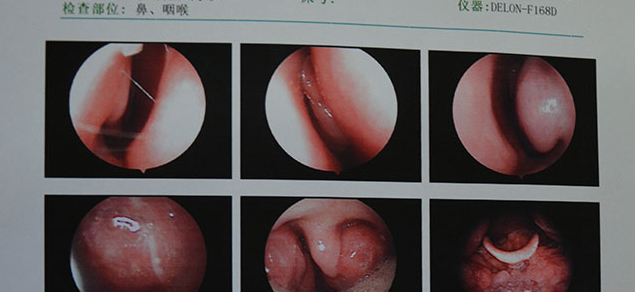 鼻咽部检查结果