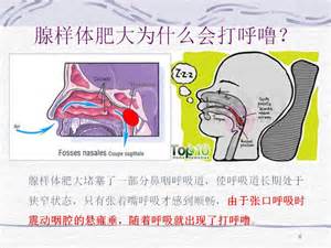 腺样体肥大为什么会打呼噜