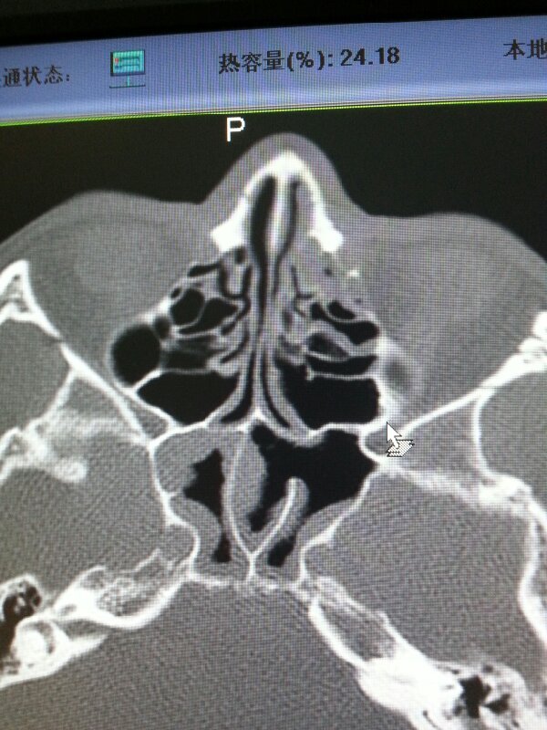 鼻部CT检查图