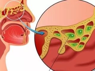 蝶窦炎的病因