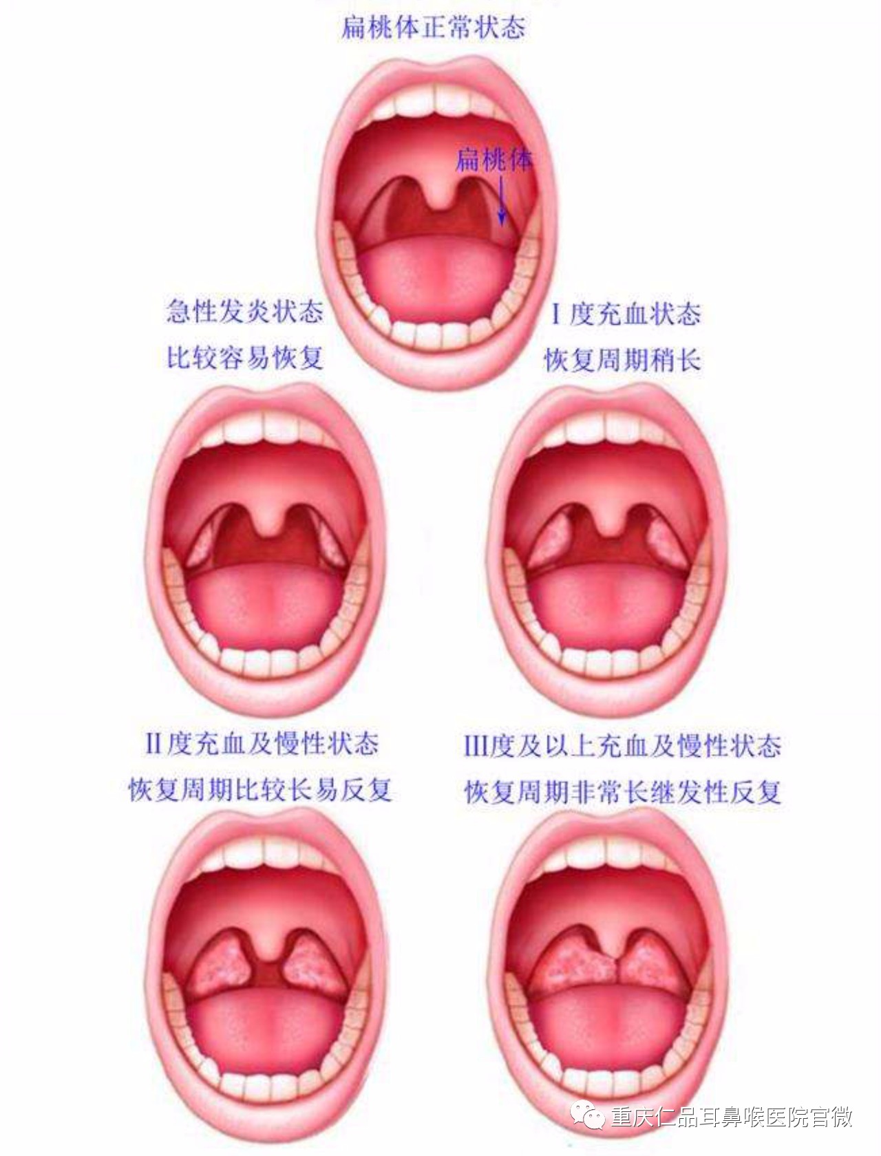 扁桃体反复发炎、肿大，孩子经常感冒、高烧不退！是割还是留？90%家长都可能选错-西南儿童康复医院