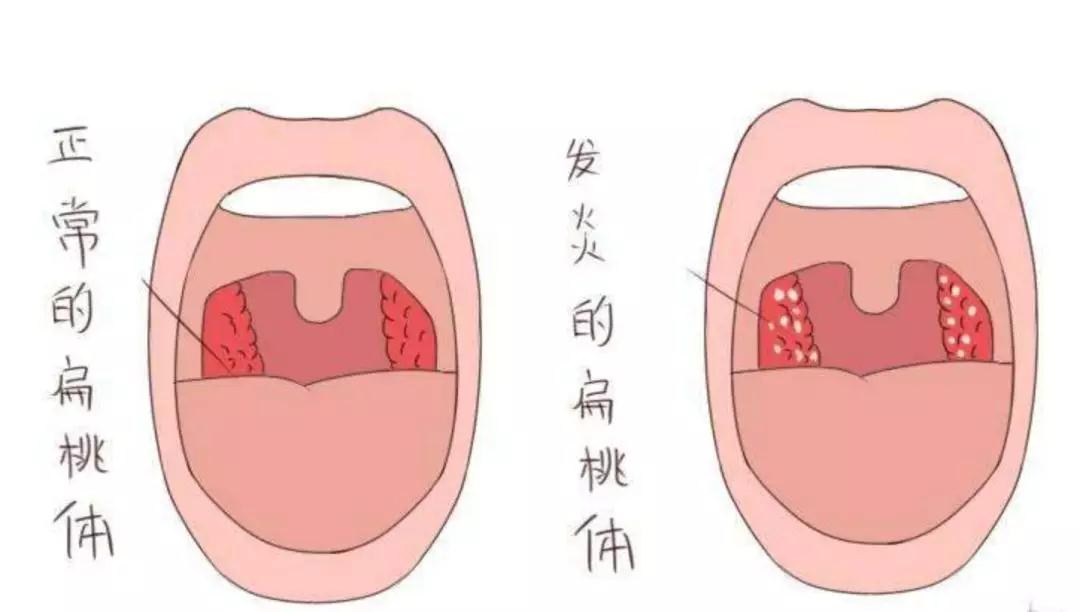 扁桃体炎的症状有哪些