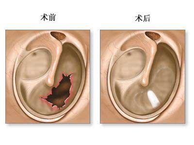 鼓膜穿孔会导致耳聋吗？