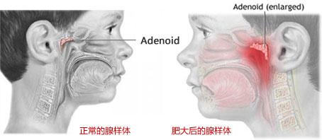 腺样体的症状