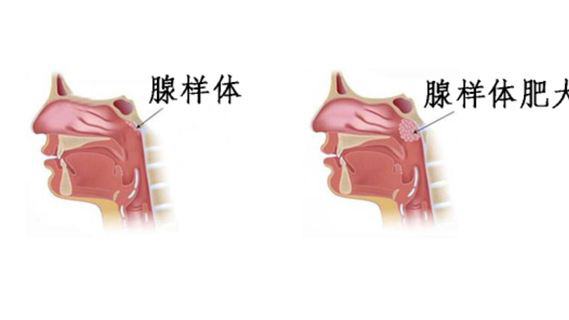 儿童腺样体肥大怎么治疗