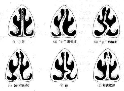 鼻中隔偏曲的症状表现