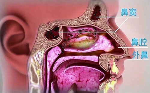 鼻窦炎的症状有哪些呢？
