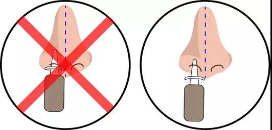 如何正确使用鼻喷雾剂