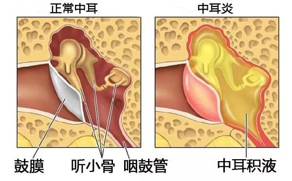 重庆中耳炎