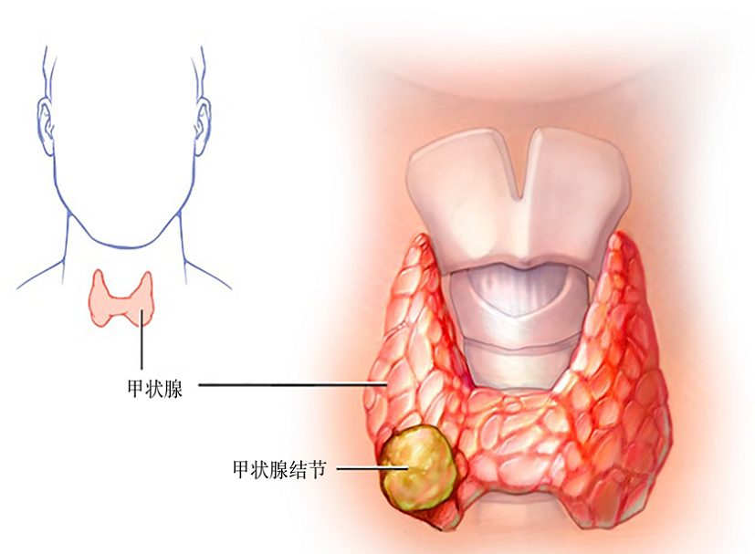 甲状腺结节