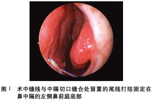  “弓”形缝线布局