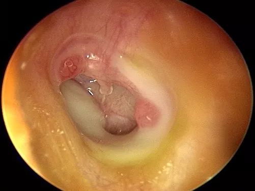 慢性化脓性中耳炎