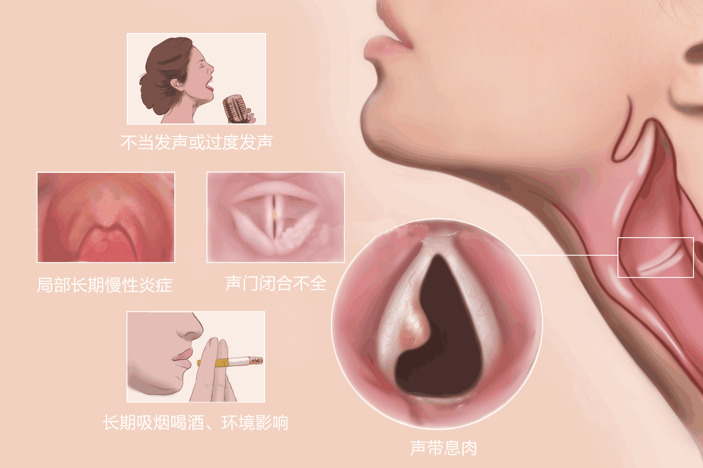 重庆治疗声带息肉医院