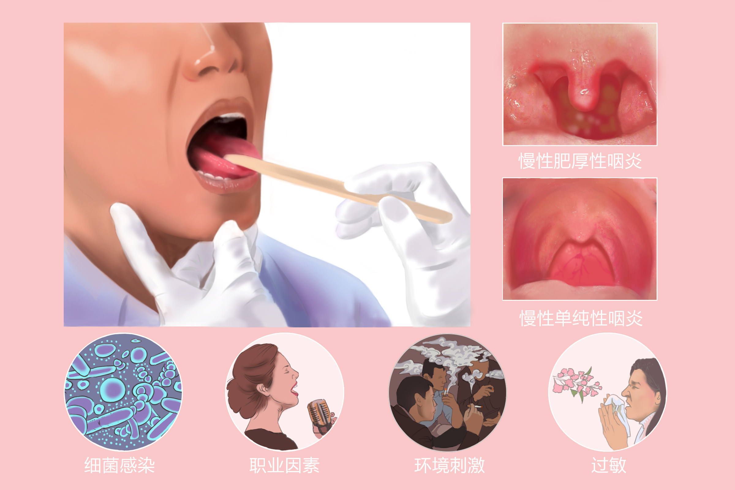 慢性咽炎的症状有哪些呢?