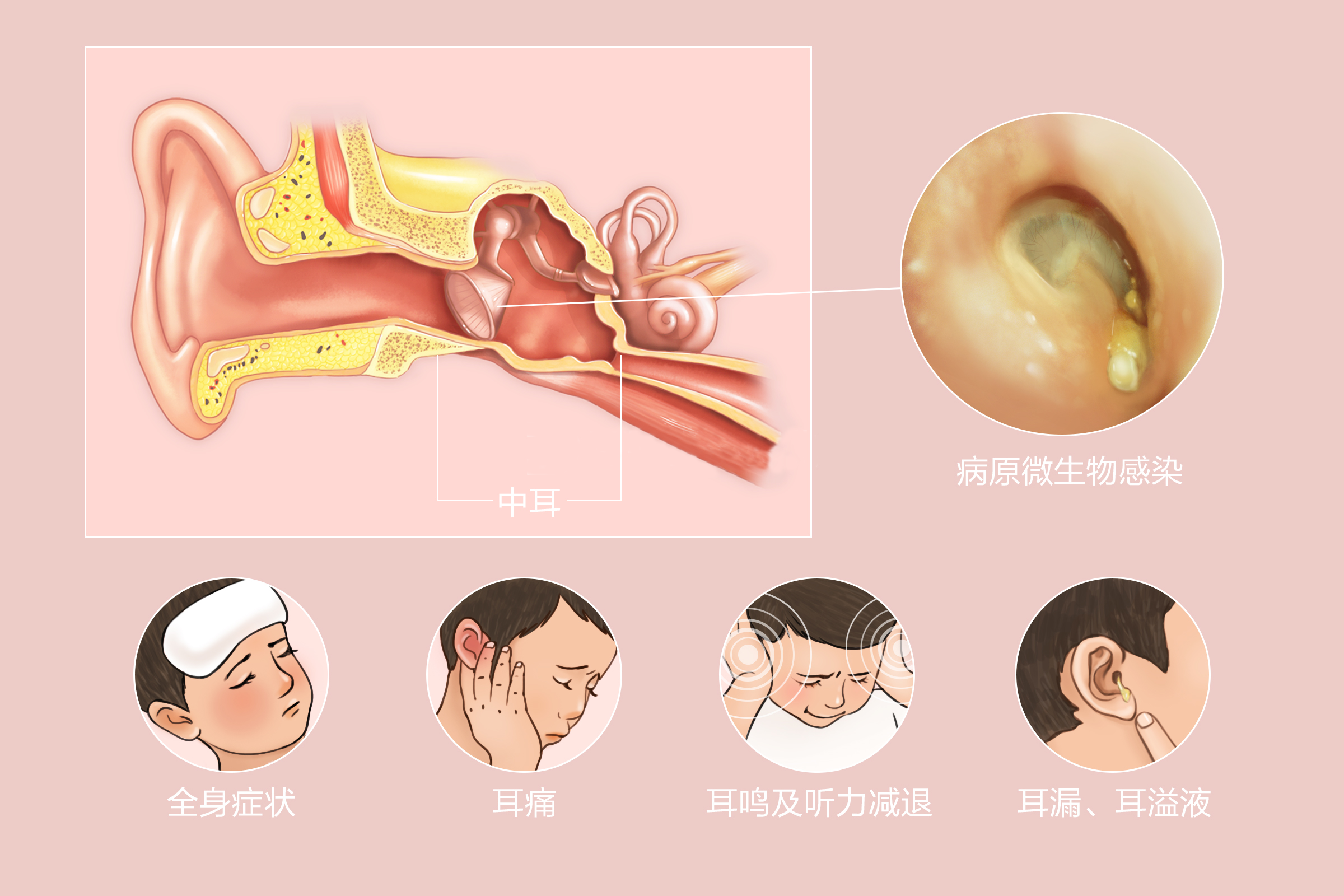 化脓性中耳炎