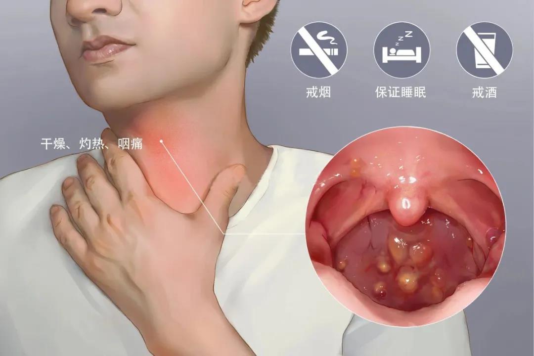 重庆耳鼻喉科医院-慢性咽炎