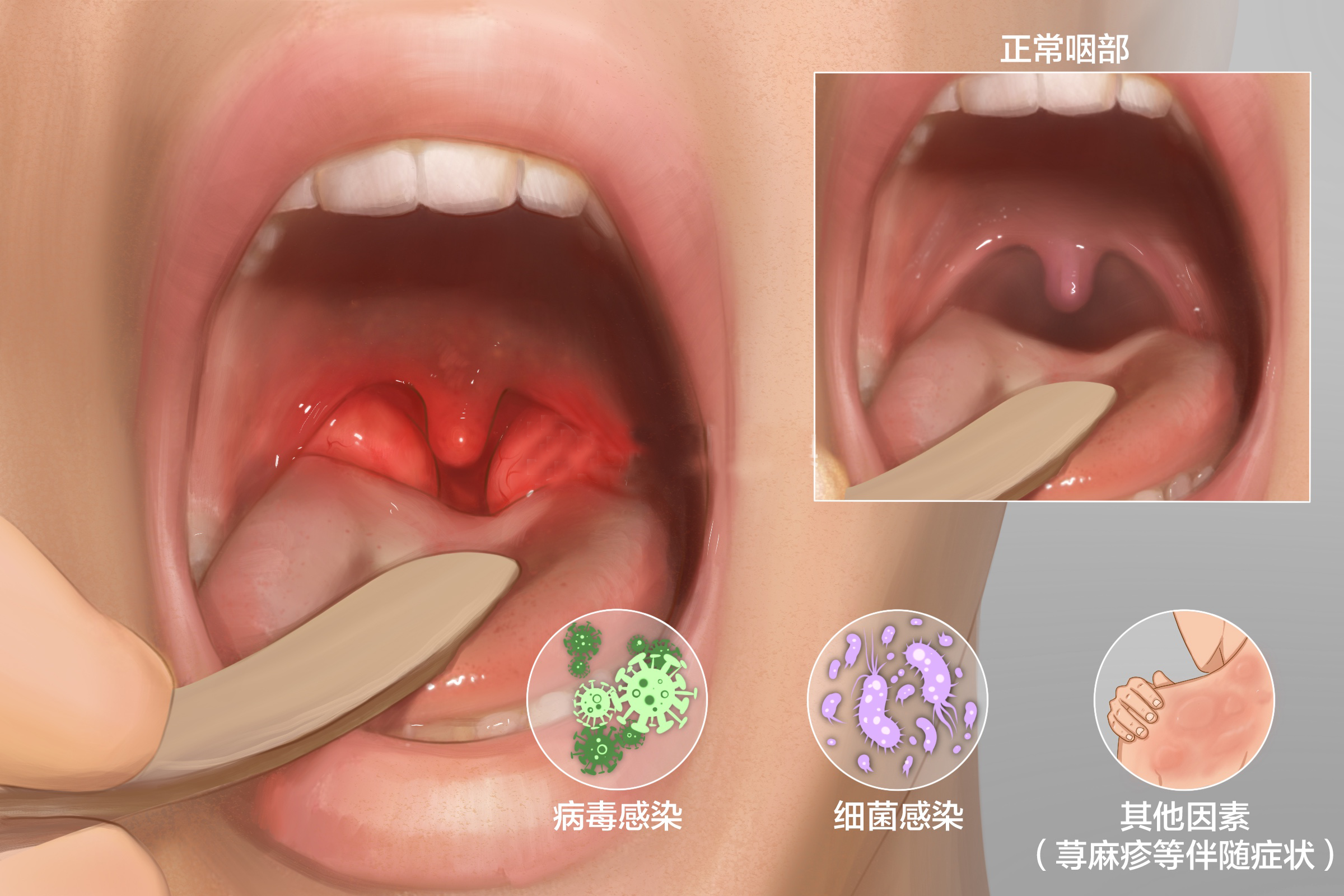 重庆耳鼻喉医院-急性咽炎